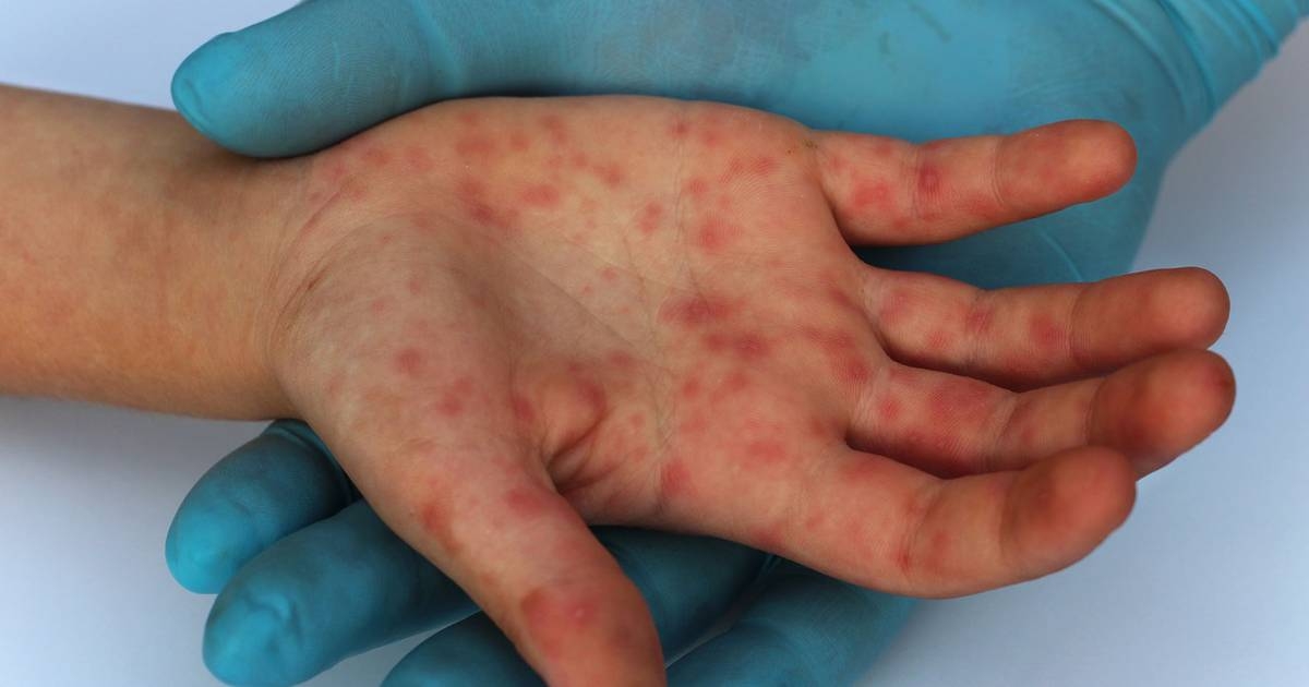 La viruela del mono, que no suele ser mortal, puede causar fiebre, dolores de cabeza, musculares o de espalda, ganglios linfáticos inflamados, escalofríos y fatiga La viruela del mono, que no suele ser mortal, puede causar fiebre, dolores de cabeza, musculares o de espalda, ganglios linfáticos inflamados, escalofríos y fatiga
