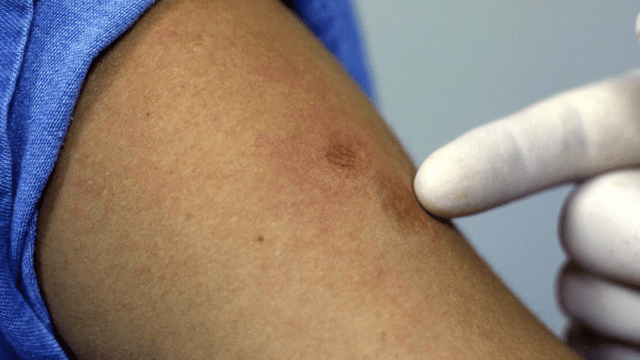 Conasida toma medidas para prevenir contagios de viruela de mono en personas que viven con VIH Conasida toma medidas para prevenir contagios de viruela de mono en personas que viven con VIH