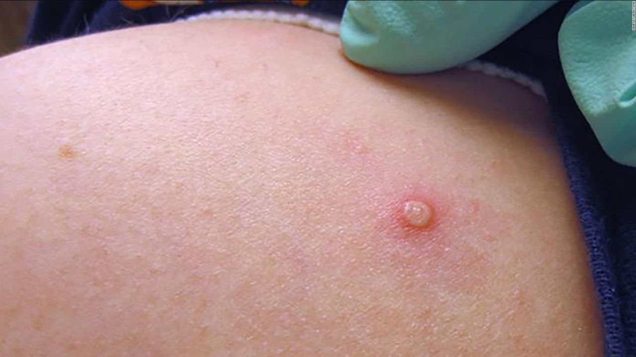 Detectan contagio de viruela del mono en un niño de 4 años en Florida