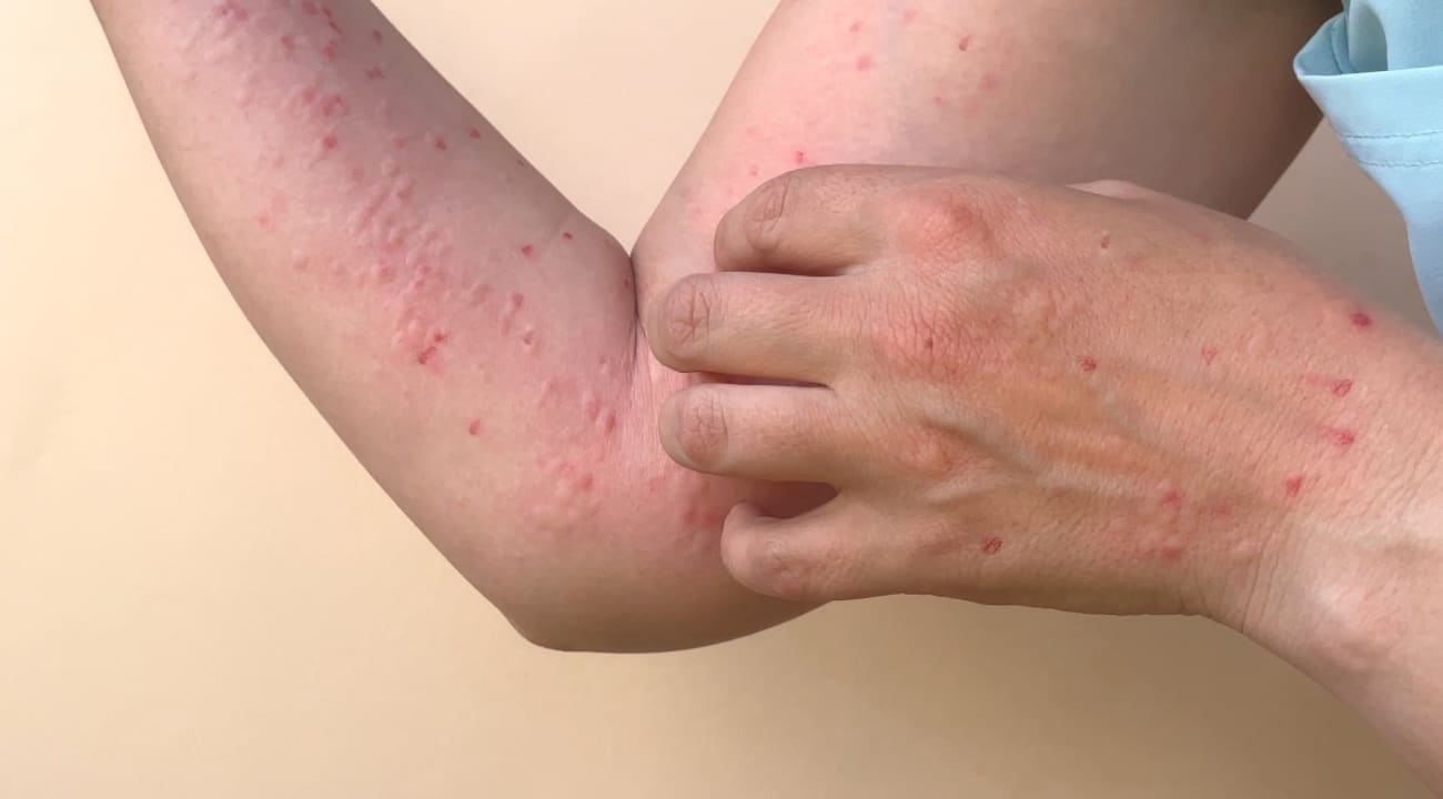 La gripe del tomate fue detectada en la Región de Kerala en India, y que afecta principalmente a menores de edad La gripe del tomate fue detectada en la Región de Kerala en India, y que afecta principalmente a menores de edad