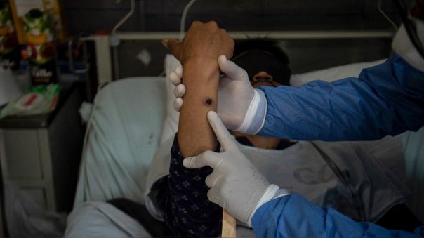 Las autoridades sanitarias cubanas informaron que al paciente se le diagnosticó la enfermedad el pasado 20 de agosto Las autoridades sanitarias cubanas informaron que al paciente se le diagnosticó la enfermedad el pasado 20 de agosto