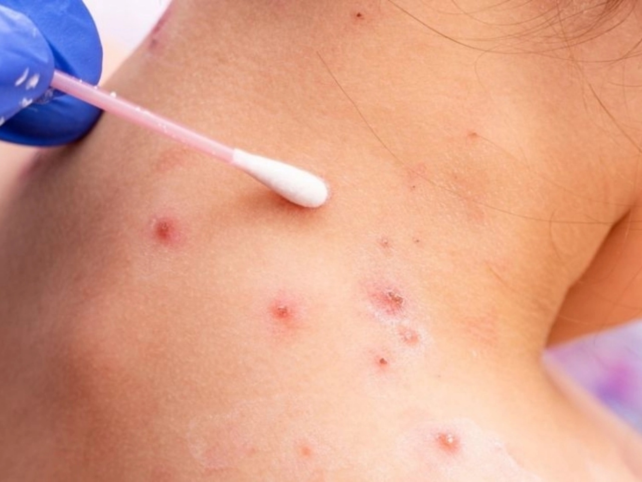 El aumento de contagios de la viruela del mono en Quintana Roo se dio a conocer este 30 de agosto por medio de la SSA