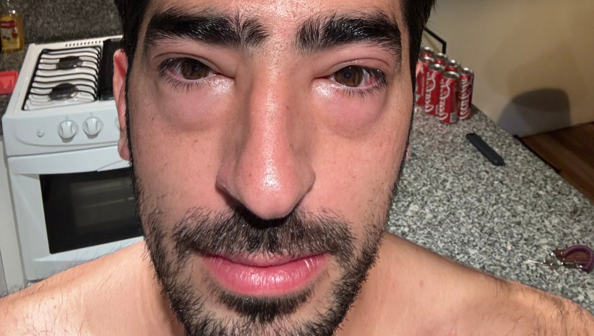 ¿Quién es Jezzini, el influencer que se convirtió en meme por su cara hinchada?