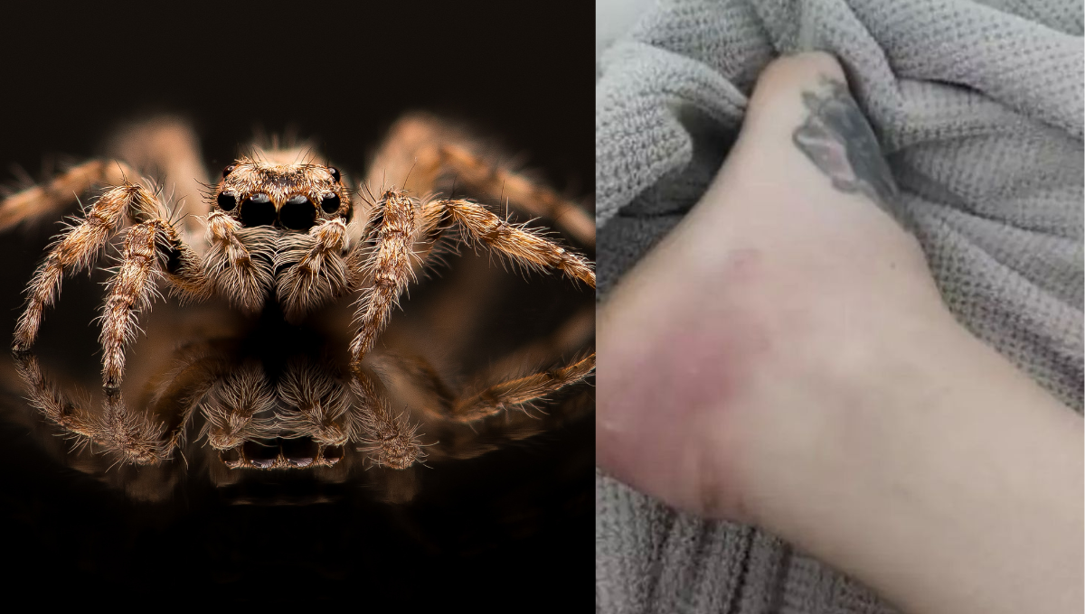 Una mujer fue picada por una araña y pierde la pierna