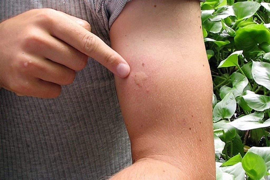 Yucatán se ubica en el segundo lugar a nivel nacional con más casos de dengue