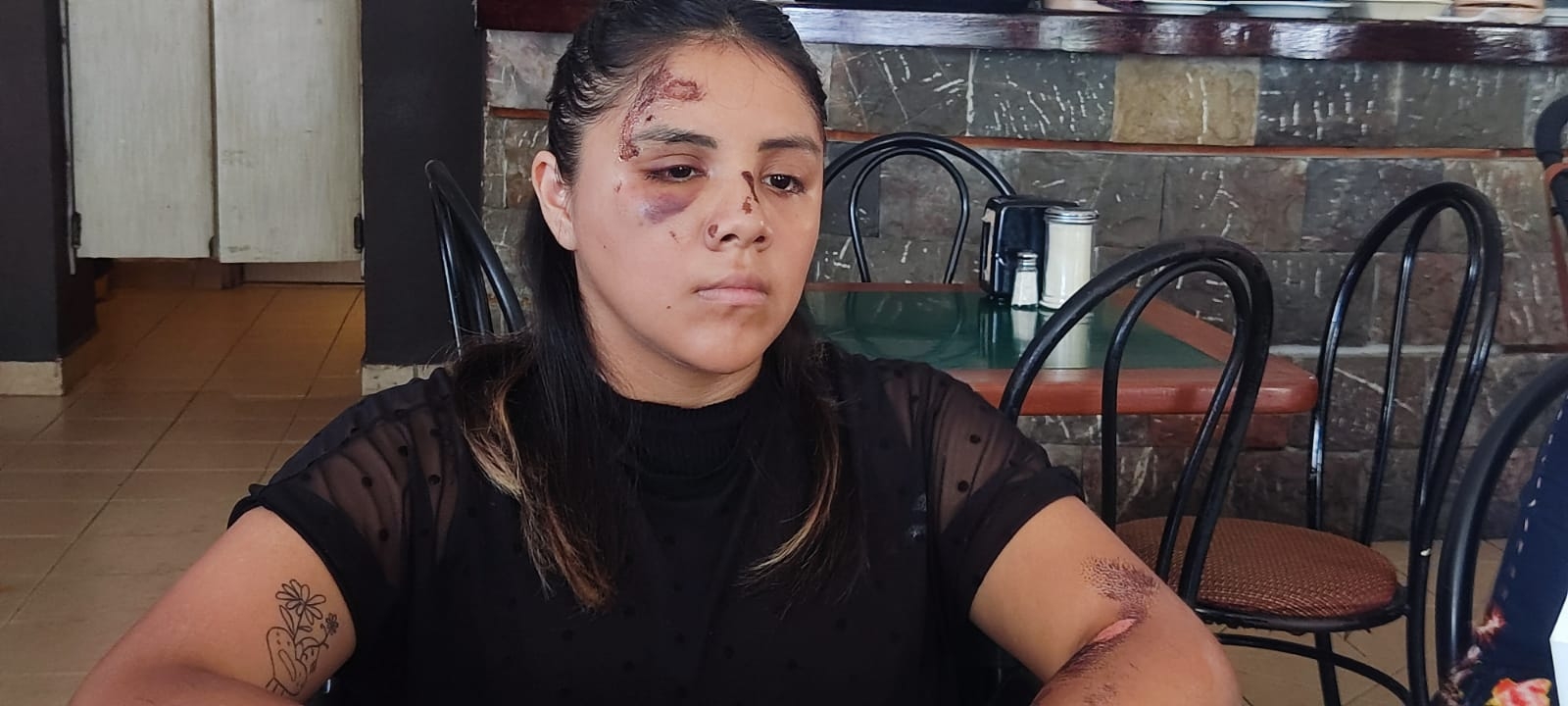 La joven presentó graves heridas tras ser atropellada