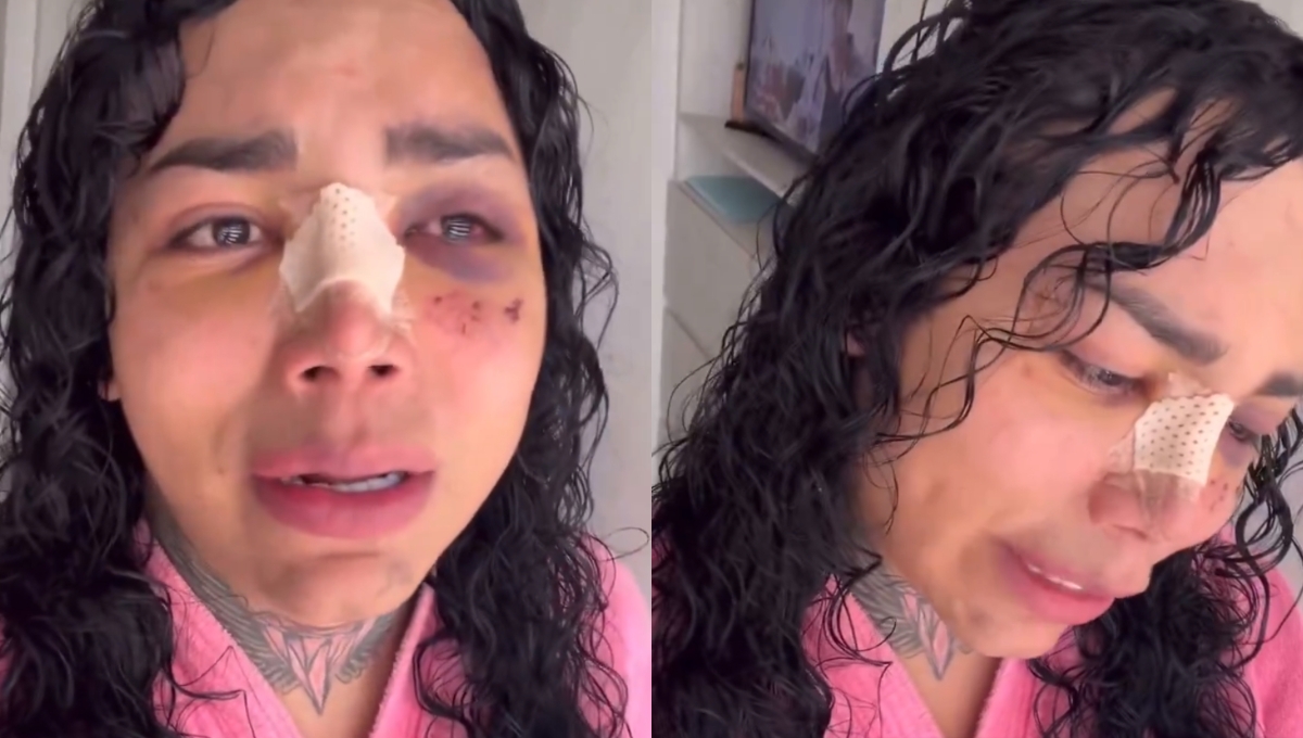 Paola Suárez ya tiene la cara menos hinchada por los golpes