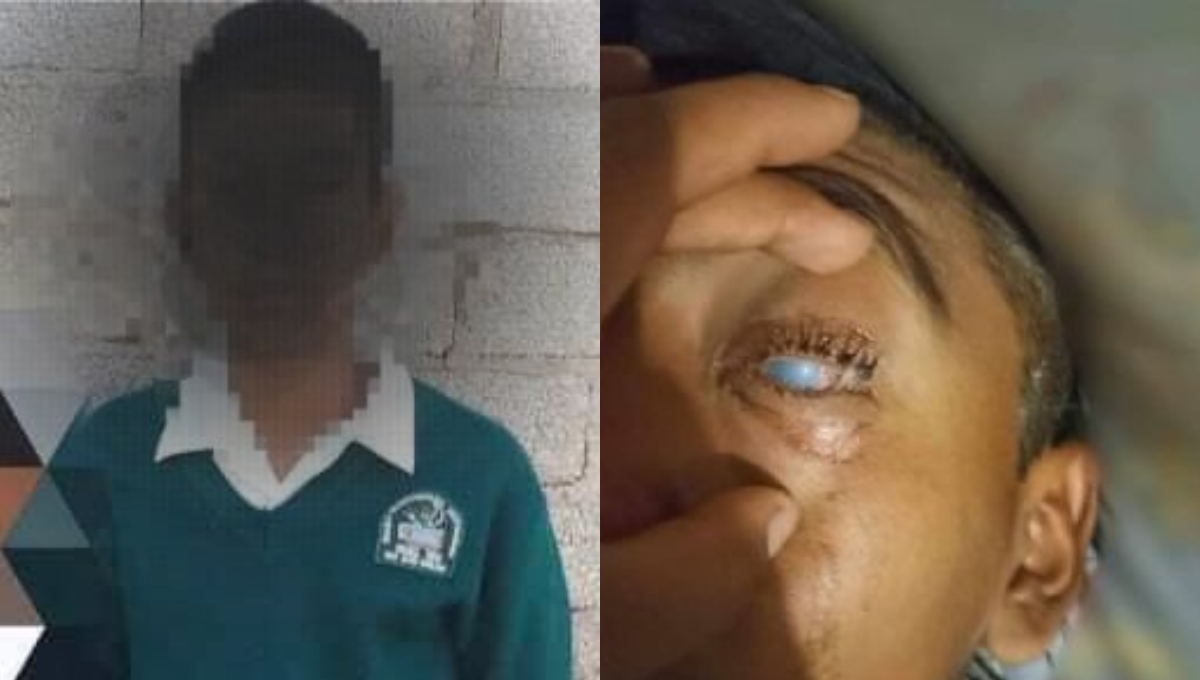 Joven queda ciego tras ser agredido por sus compañeros con agua y cal en Oaxaca