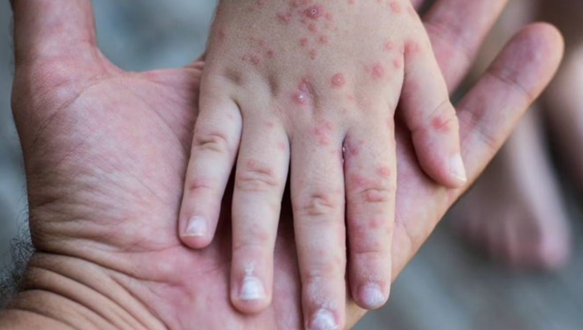 Establecen cerco sanitario por brote de “virus coxsackie” en Hidalgo Establecen cerco sanitario por brote de “virus coxsackie” en Hidalgo